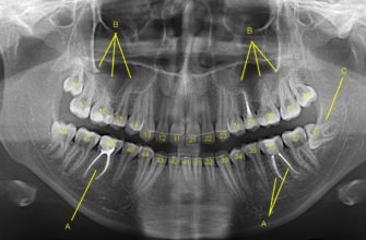 нейронную сеть для обнаружения кариеса на снимках зубов!